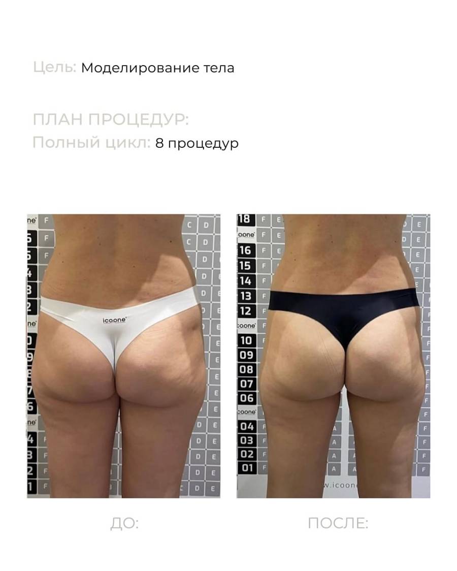 До и после: моделирование тела, 8 процедур