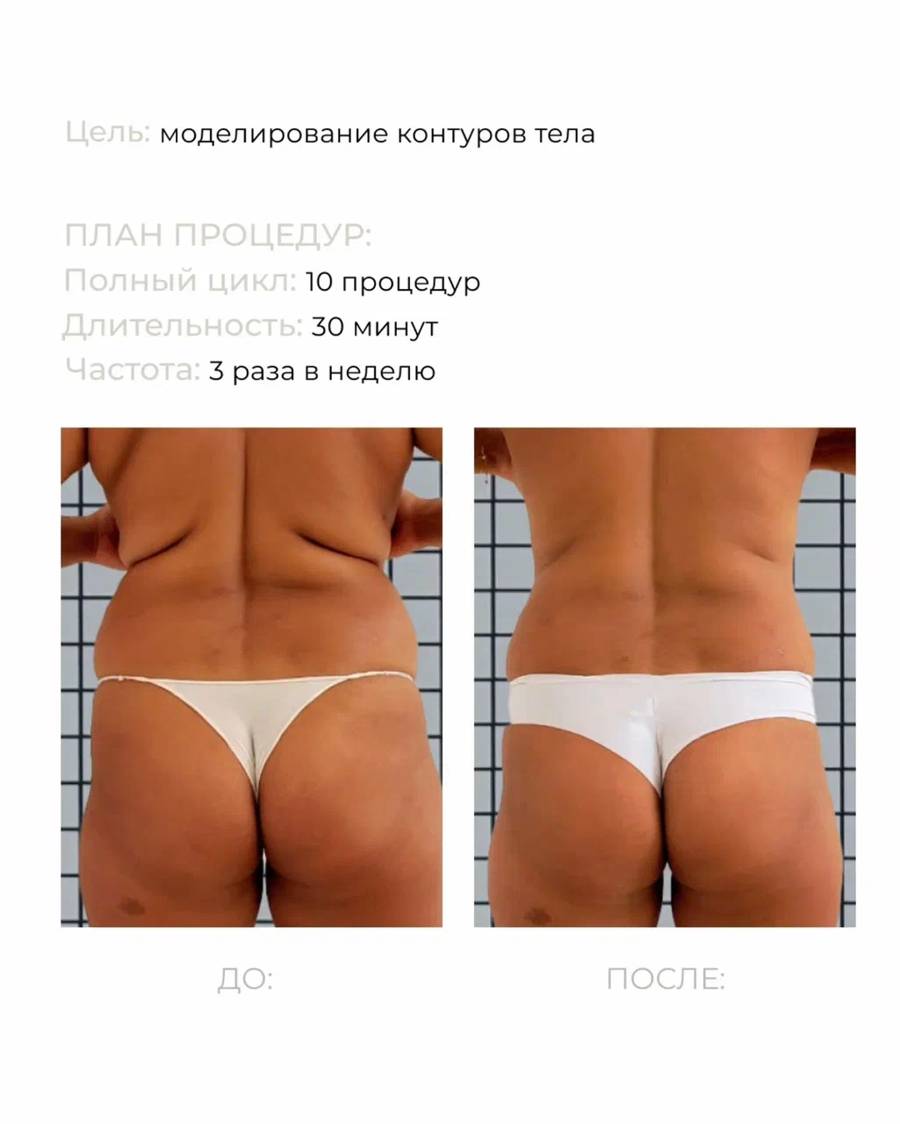 До и после: моделирование контуров тела, 10 процедур